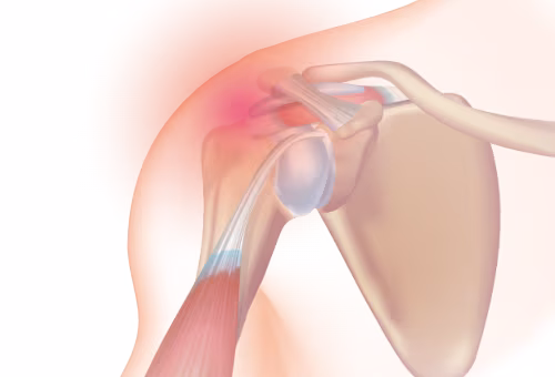 Shoulder Pain image from From Injury Map . com